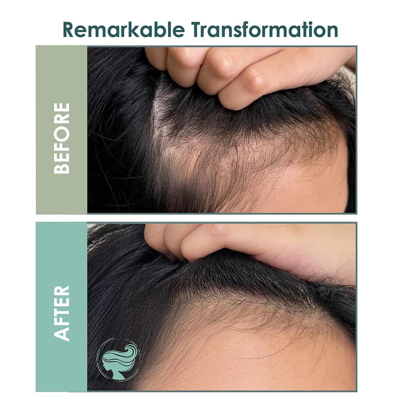 Sh Rd SH-RD Intensive Scalp Essence for Hair Regrowth & Volumizing | With Rosemary, Protein, Vitamin B5 | Lightweight Serum for Thinning Hair - 50ml/1.69oz - Image 5